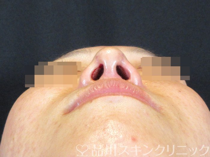 症例NO.75373のAFTER写真