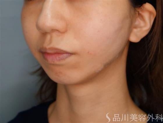 症例NO.54720のAFTER写真