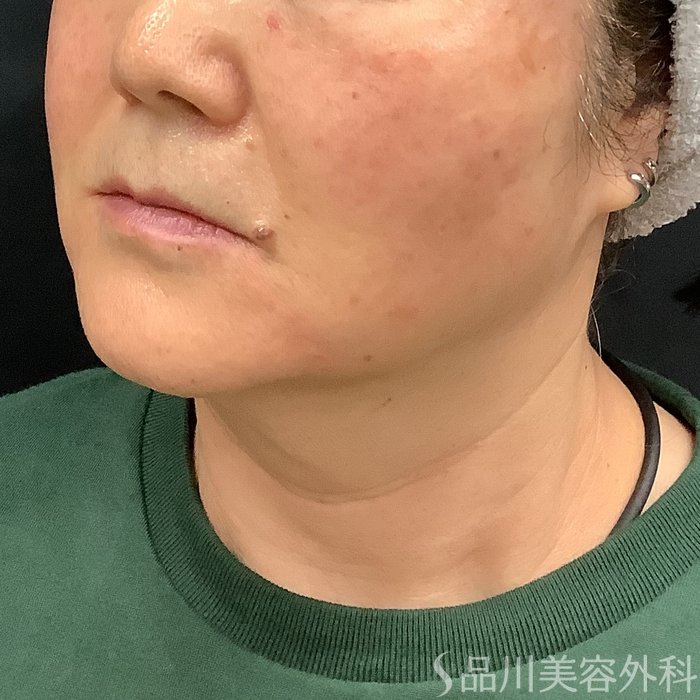 症例NO.75332のAFTER写真