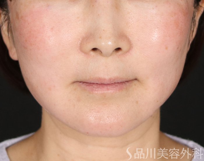 症例NO.72077のAFTER写真