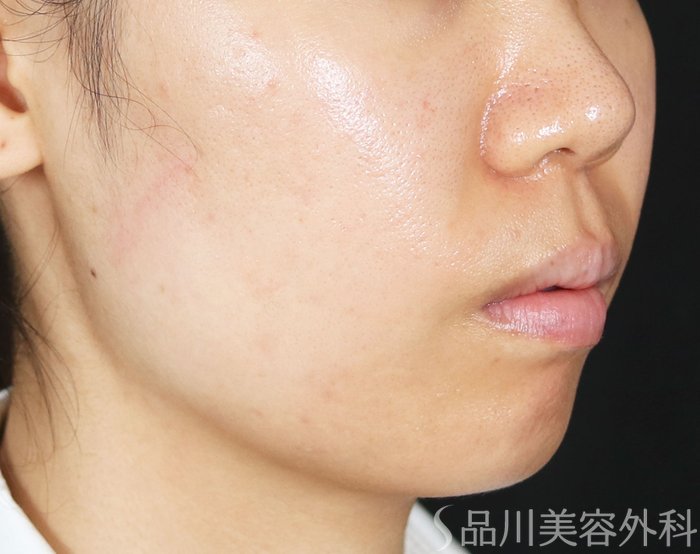 症例NO.71765のAFTER写真