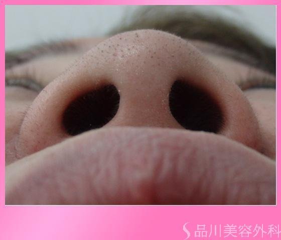 症例NO.13894のBEFORE写真