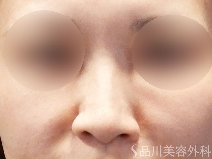 症例NO.68109のBEFORE写真