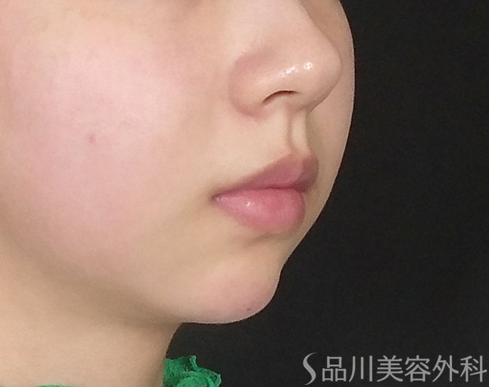 症例NO.71688のAFTER写真