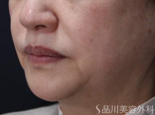 症例NO.69288のBEFORE写真