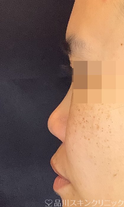 症例NO.69986のBEFORE写真