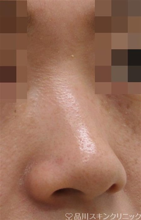 症例NO.42153のBEFORE写真