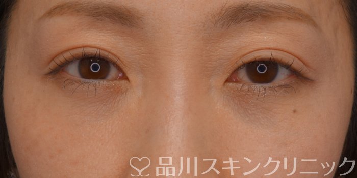 症例NO.74856のBEFORE写真