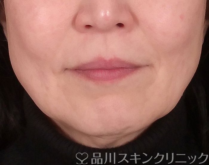 症例NO.69428のBEFORE写真