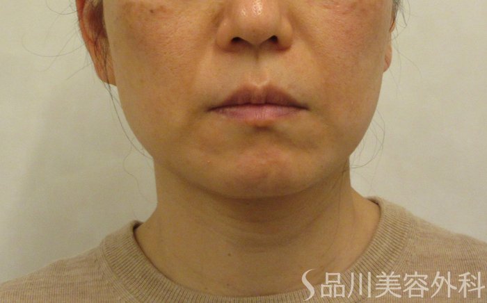 症例NO.72089のBEFORE写真