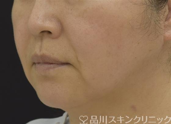 症例NO.58978のAFTER写真