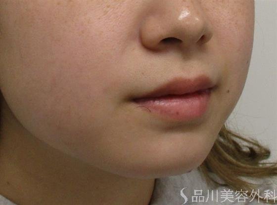 症例NO.53826のBEFORE写真