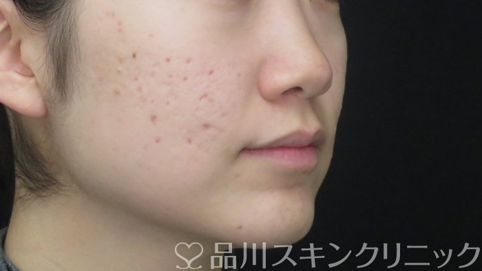 症例NO.72685のBEFORE写真