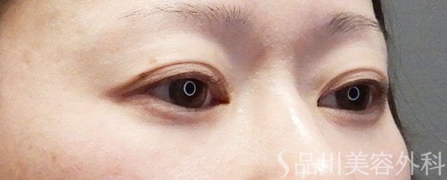 症例NO.74127のBEFORE写真