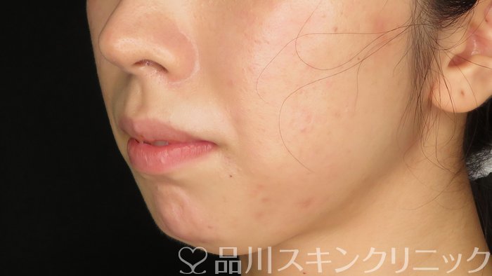 症例NO.71286のBEFORE写真