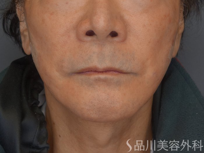 症例NO.72093のAFTER写真