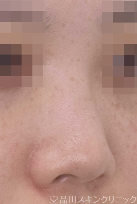症例NO.67497のBEFORE写真
