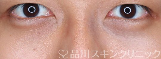 症例NO.70518のAFTER写真