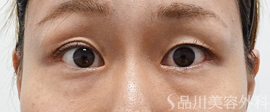 症例NO.69806のBEFORE写真