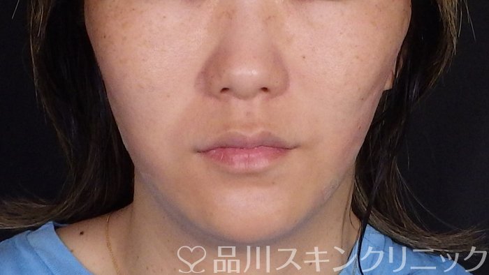 症例NO.72885のAFTER写真