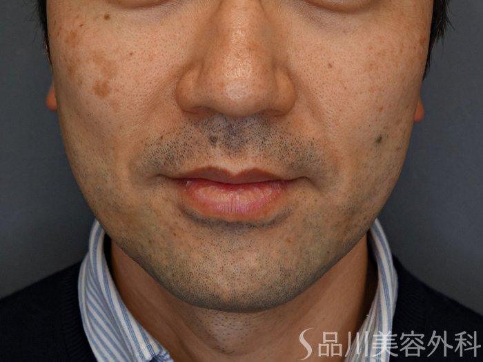症例NO.74814のBEFORE写真