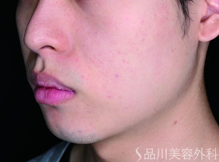 症例NO.72701のAFTER写真