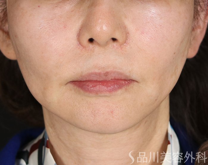 症例NO.72741のAFTER写真