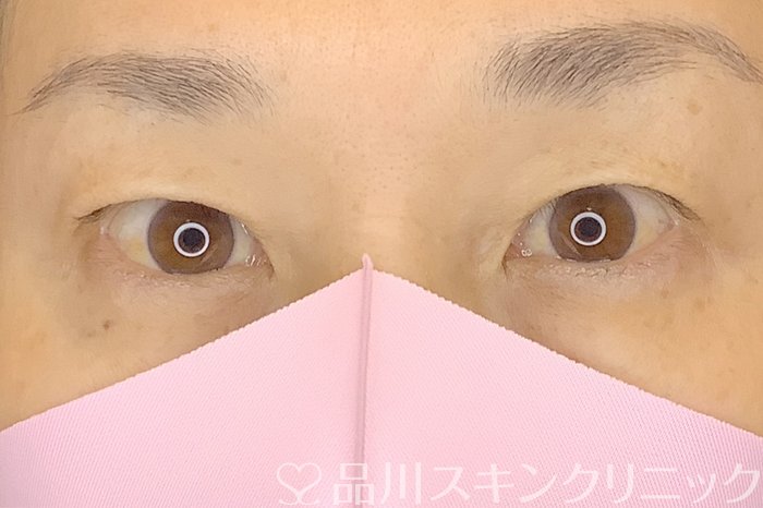 症例NO.65265のBEFORE写真
