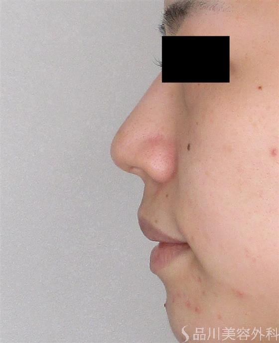 症例NO.59198のBEFORE写真