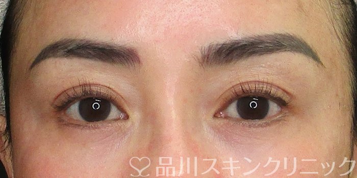 症例NO.70132のAFTER写真