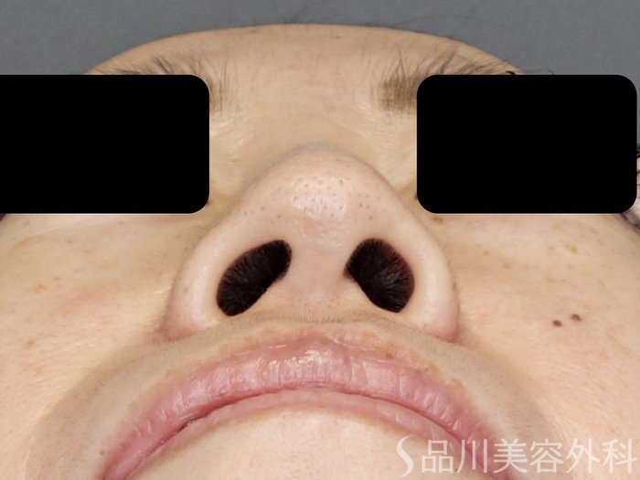 症例NO.72632のBEFORE写真