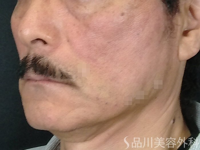 症例NO.70697のAFTER写真