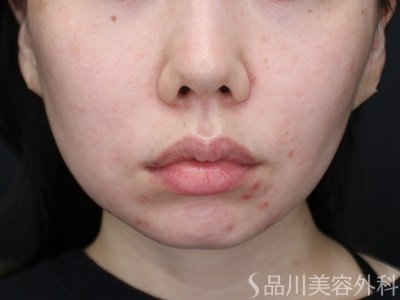 症例NO.72647のBEFORE写真