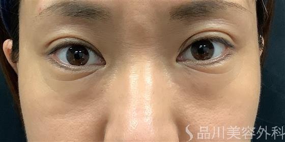 症例NO.60648のBEFORE写真
