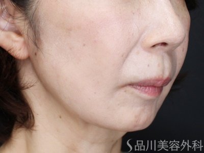 症例NO.71302のAFTER写真