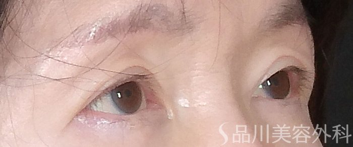 症例NO.68059のAFTER写真
