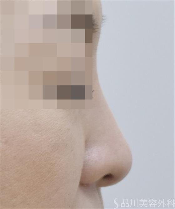 症例NO.46181のAFTER写真