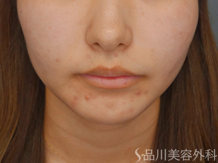 症例NO.70841のBEFORE写真