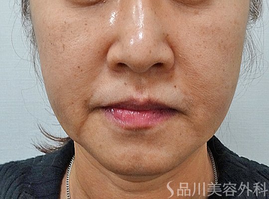 症例NO.73847のBEFORE写真
