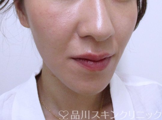 症例NO.65058のBEFORE写真