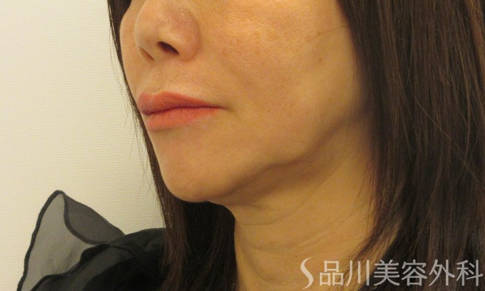 症例NO.73083のAFTER写真