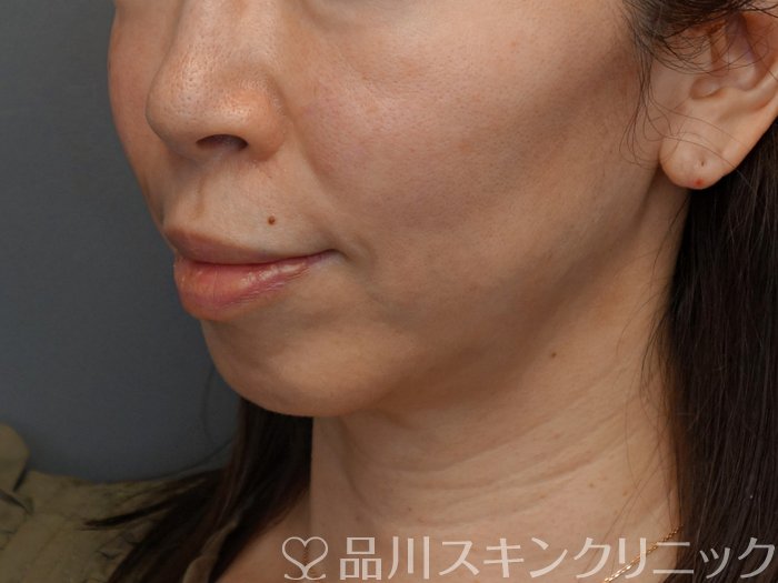 症例NO.74615のBEFORE写真