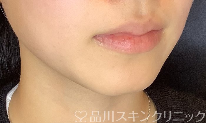 症例NO.70269のBEFORE写真