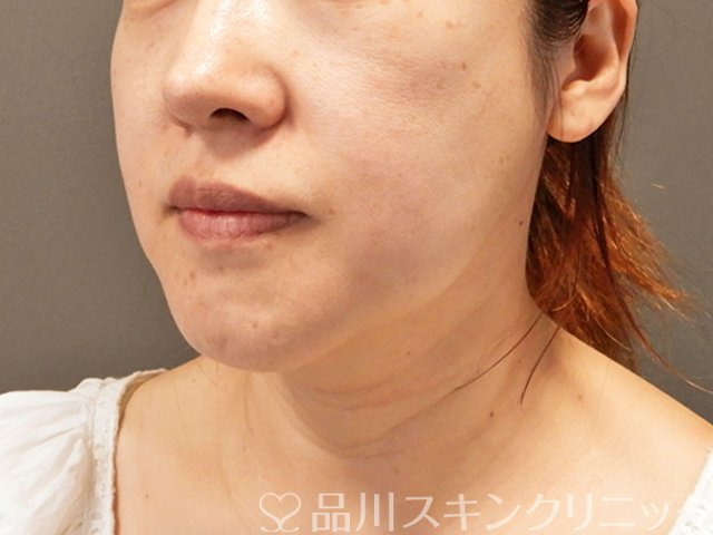 症例NO.70932のBEFORE写真