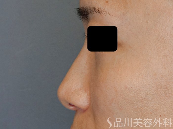 症例NO.71151のBEFORE写真