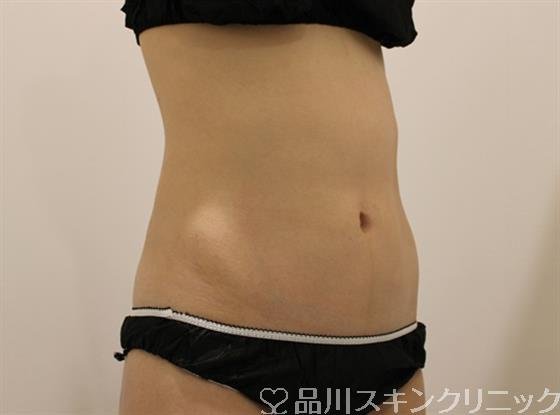 症例NO.45099のAFTER写真