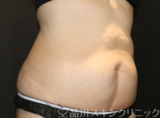 症例NO.72950のBEFORE写真