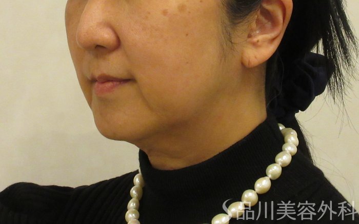 症例NO.72374のBEFORE写真