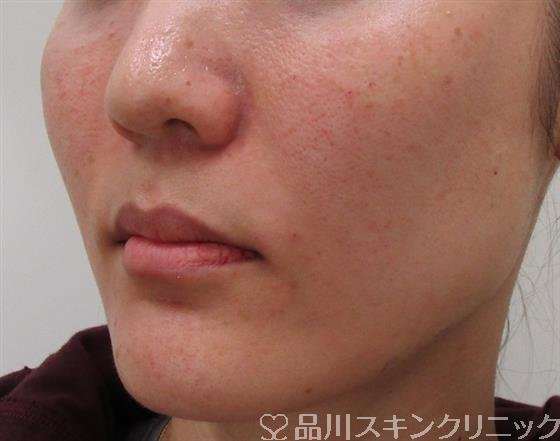 症例NO.32642のAFTER写真
