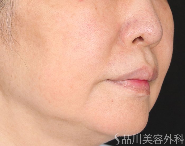 症例NO.71180のBEFORE写真